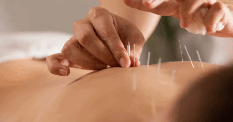 Acupuncture Singapore: A Holistic Approach to Health and Wellness